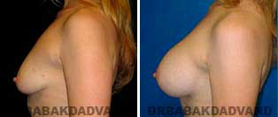 Breast Augmentation. Before and After Photos. 32 year old woman - left side view