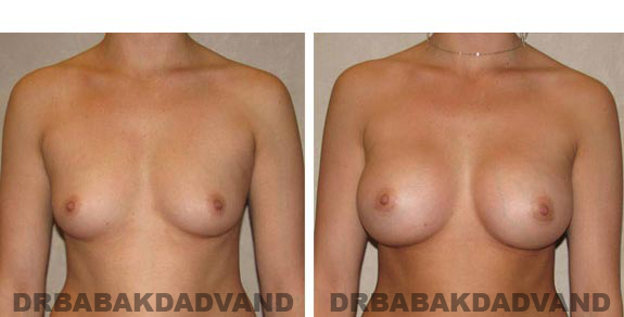 Breast-Augmentation: Before & After Photos - Female, front view