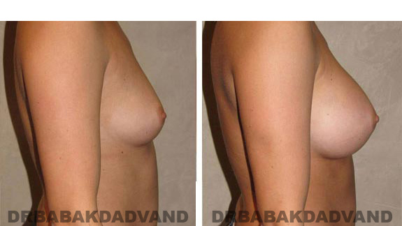 Breast-Augmentation: Before & After Photos - Female, right side view