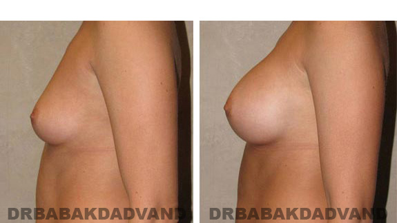 Breast-Augmentation: Before & After Photos - Female, left side view