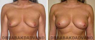 Breast Augmentation. Before and After Photos. 22 year old woman - front view