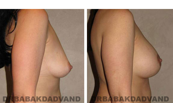 Before and After Photos. Breast-Breastlift: - 45 year old female, right side view