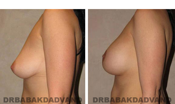 Before & After Photos. Breast-Augmentation:  - Woman, left side view