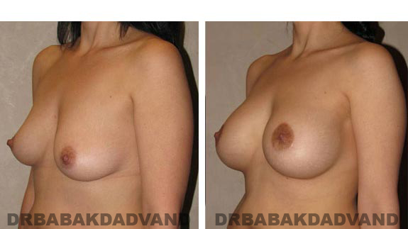 Before and After Photos. Breast-Breastlift: - 45 year old female, left side, oblique view