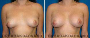 Breast Augmentation. Before and After Photos. 27 year old woman - front view