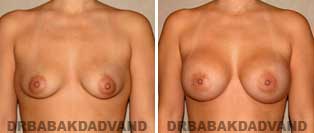 Breast Augmentation. Before & After Photos. 32 year old woman - front view