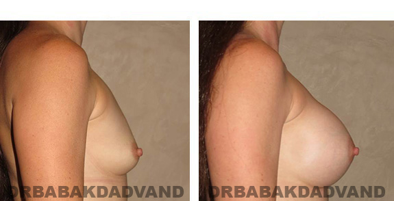 Before & After Photos. Breast-Augmentation: - 30 year old female, right side view