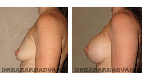Before & After Photos. Breast-Augmentation: - 30 year old female, left side view