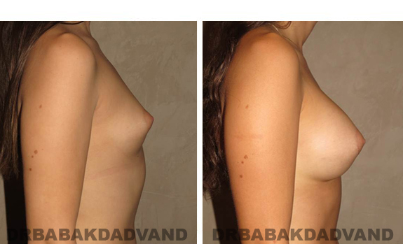 Breast-Augmentation: Before and After Photos - Female, right side view