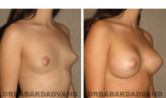 Breast-Augmentation: Before and After Photos - Female, right side, oblique view