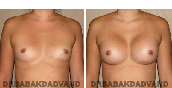 Before and After Photos. Breast-Augmentation: - 23 year old female, front view