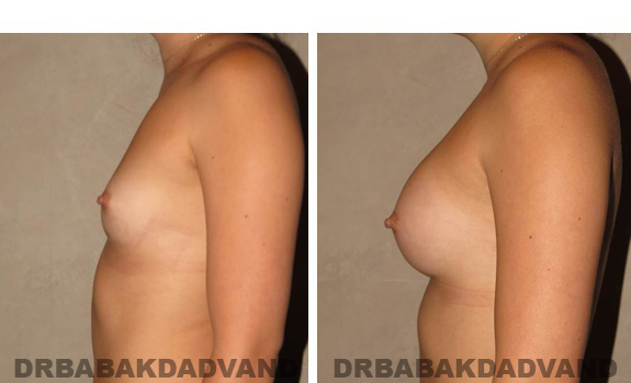 Before and After Photos. Breast-Augmentation: - 23 year old female, left side view