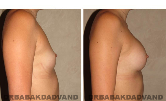 Before and After Photos. Breast-Augmentation: - 23 year old female, right side view