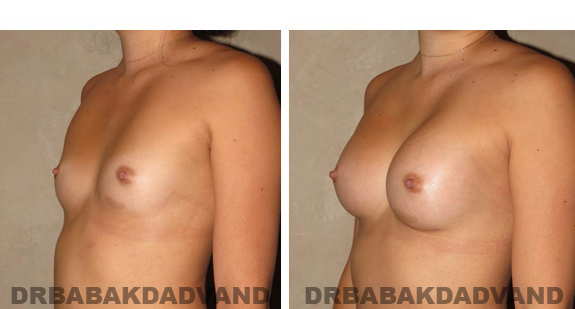 Before and After Photos. Breast-Augmentation: - 23 year old female, left side, oblique view