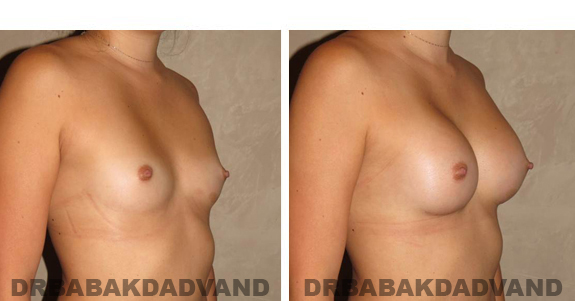 Before and After Photos. Breast-Augmentation: - 23 year old female, right side, oblique view