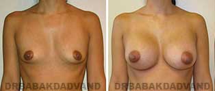 Breast Augmentation. Before & After Photos. 20 year old female frontal view