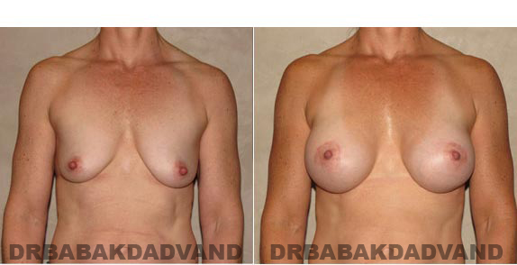 Breast-Augmentation: Before & After Photos - Woman, front view