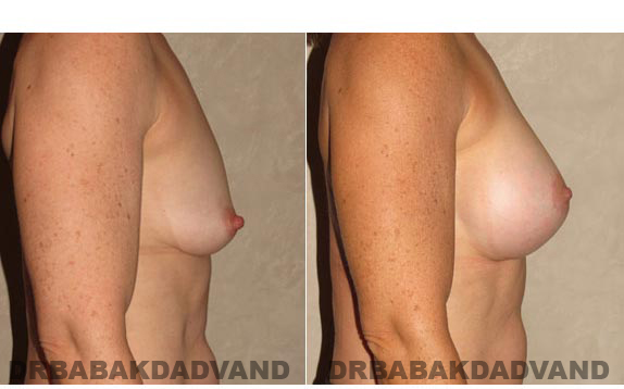 Breast-Augmentation: Before & After Photos - Woman, right side view