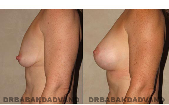 Breast-Augmentation: Before & After Photos - Woman, left side view