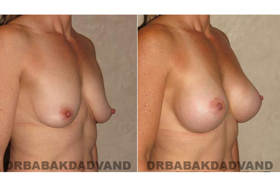 Breast-Augmentation: Before & After Photos - Woman, right side, oblique view