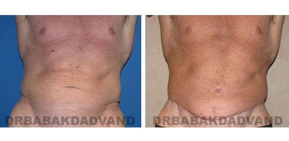 Before - After Photos |Bodylift| 62 year old male, - front view