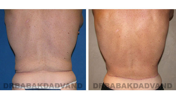 Before - After Photos |Bodylift| 62 year old male, - back view