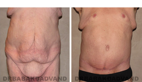 Before - After Photos |Bodylift| 40 year old male, - front view