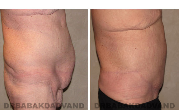 Before - After Photos |Bodylift| 40 year old male, - right side view