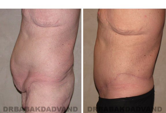 Before - After Photos |Bodylift| 40 year old male, - left side view