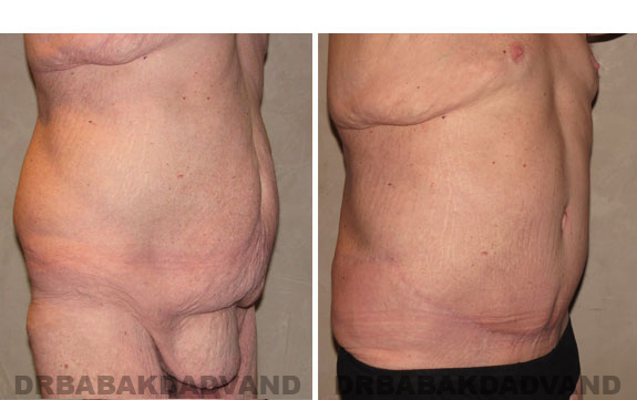 Before - After Photos |Bodylift| 40 year old male, - right side,oblique view