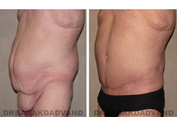 Before - After Photos |Bodylift| 40 year old male, - left side,oblique view