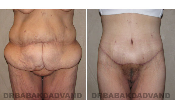 Before - After Photos |Bodylift| 55 year old female, - front view