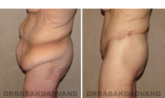 Before - After Photos |Bodylift| 55 year old female, - left side view