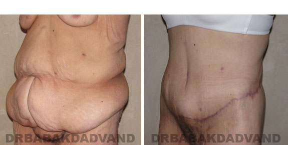 Before - After Photos |Bodylift| 55 year old female, - left side,oblique view