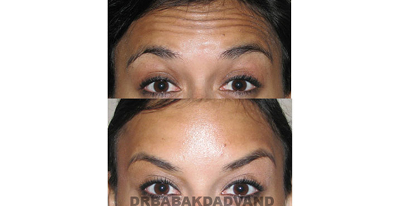 Before - After Photos |Botox| woman - front view