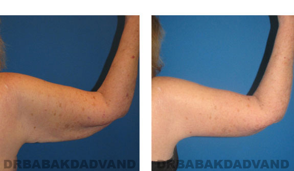 Before - After Photos |Brachioplasty| 66 year old female, right hand, back view