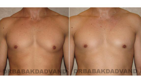 Breast-Gynecomastia: Before and After Photos. 26 year old man, front view