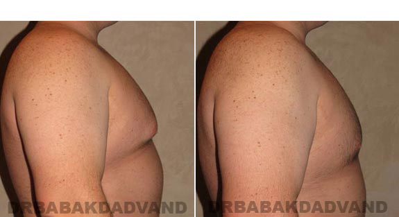 Breast-Gynecomastia: Before and After Photos. 28 year old man, -right side view