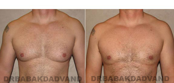 Breast-Gynecomastia: Before and After Photos. 39 year old man, - front view