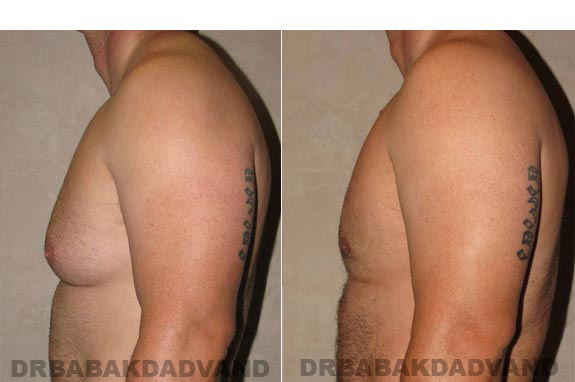 Breast-Gynecomastia: Before and After Photos. 39 year old man, -left side view