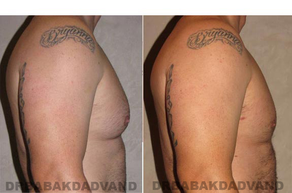 Breast-Gynecomastia: Before and After Photos. 39 year old man, -right side view