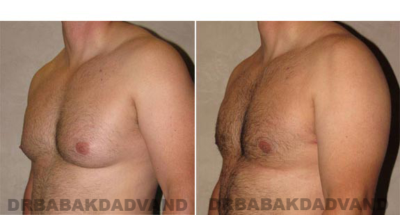 Breast-Gynecomastia: Before and After Photos. 39 year old man, -left side, oblique view