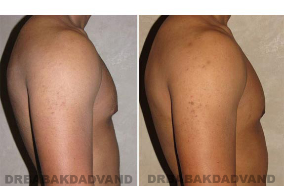 Breast-Gynecomastia: Before and After Photos. 23 year old man, -right side view