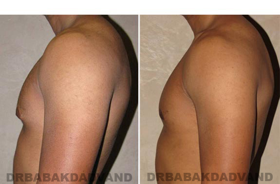 Breast-Gynecomastia: Before and After Photos. 23 year old man, -left side view