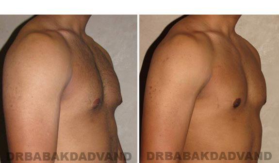 Breast-Gynecomastia: Before and After Photos. 23 year old man, -right side, oblique view