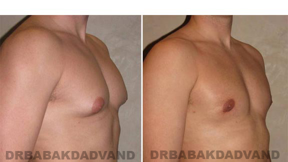 Breast-Gynecomastia: Before and After Photos. 24 year old man, -right side, oblique view