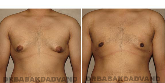 Before and After Photos -Gynecomastia - 23 year old male, - front view