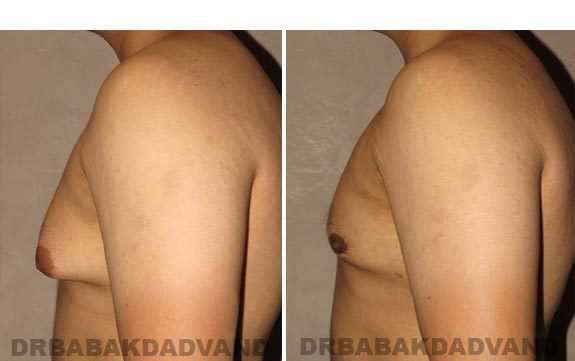 Before and After Photos -Gynecomastia - 23 year old male, -left side view