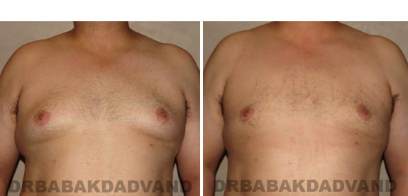 Before and After Photos -Gynecomastia - 35 year old male, - front view