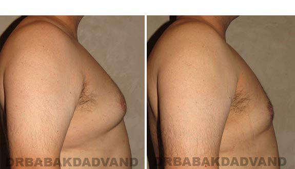 Before and After Photos -Gynecomastia - 35 year old male, -right side view